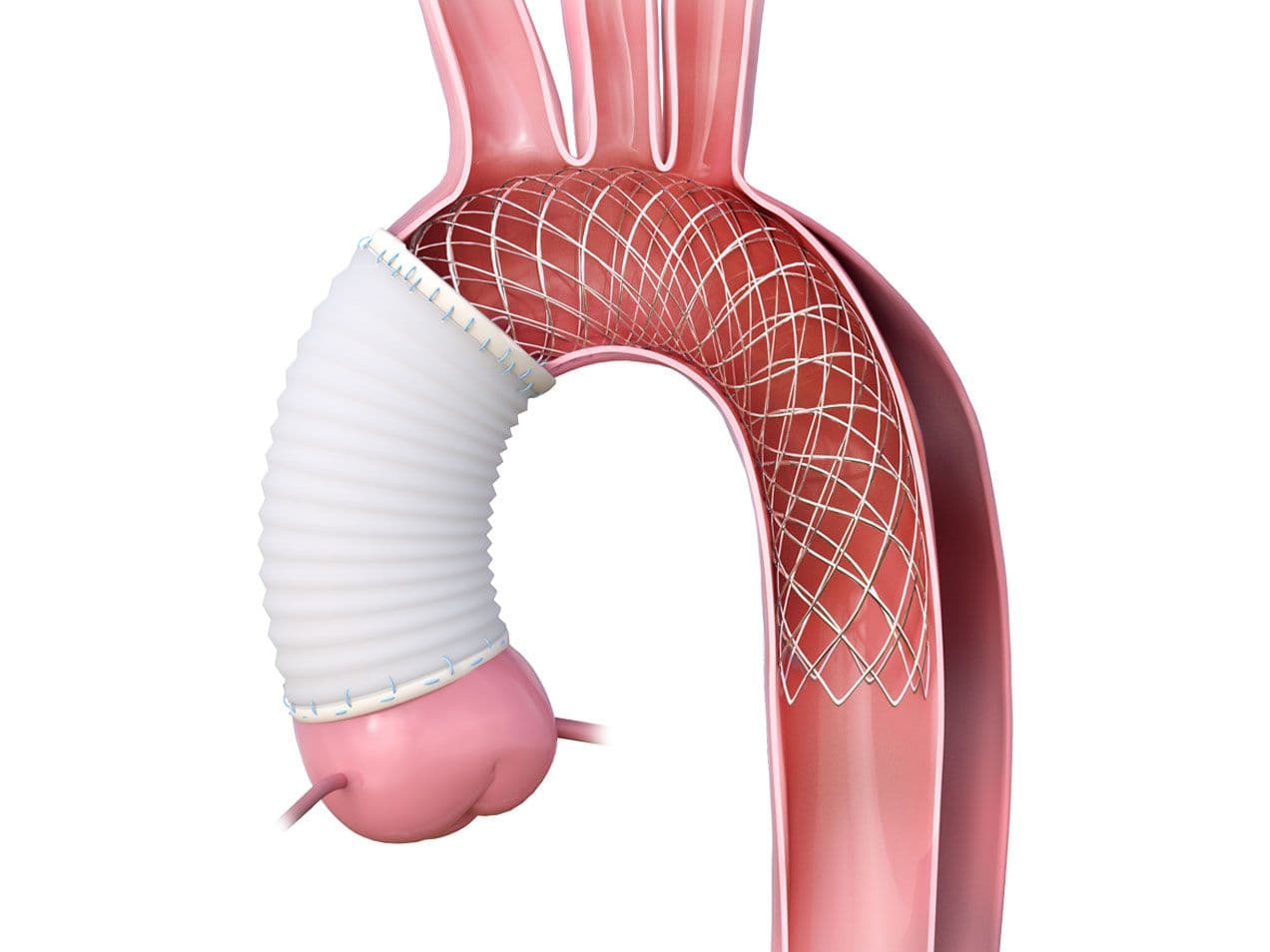AMDS™ Open Surgery Dissection Stent